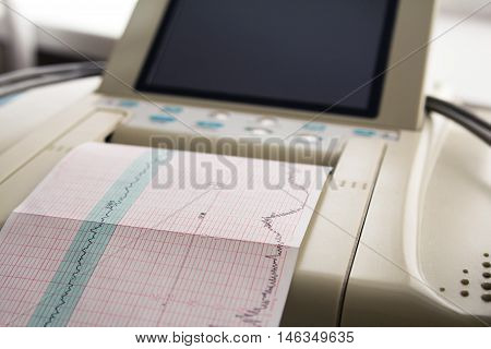 Printing of cardiogram report coming out from Electrocardiograph in labour ward. Fetal monitor