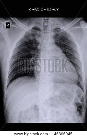 xray image show heart disease and cardiomegaly