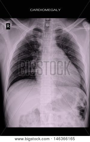 xray image show heart disease and cardiomegaly