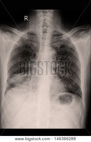 Chest xray PA upright show lung cancer and metastasis
