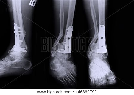 Ankle right joint : fracture ankle right joint