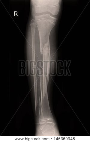 Xray right leg show closed fracture tibia and fibula