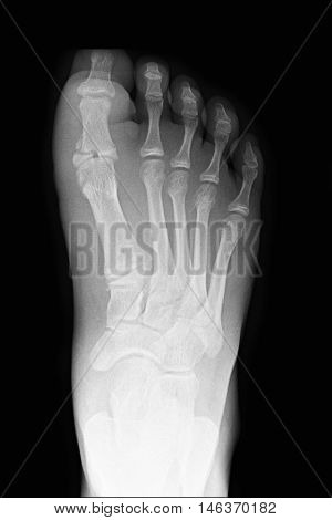 xray image show closed fracture index toe right foot