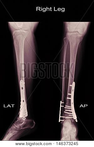 xray image show closed fracture fibula and tibia and post operation