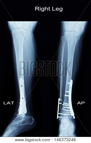 xray image show closed fracture fibula and tibia and post operation