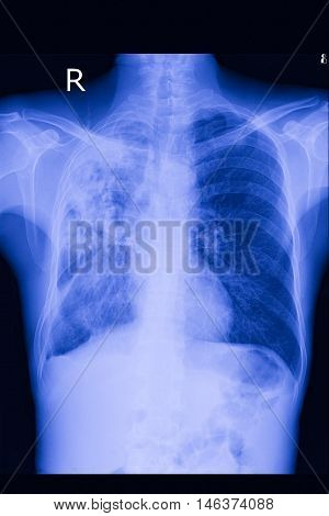 chest xray PA upright show lung metastasis