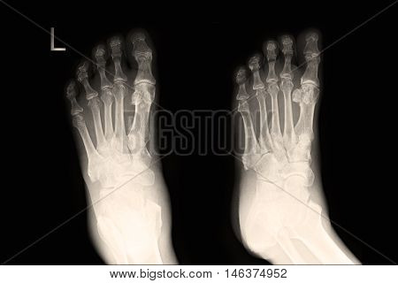 xray image show left foot AP,LAT  and fracture