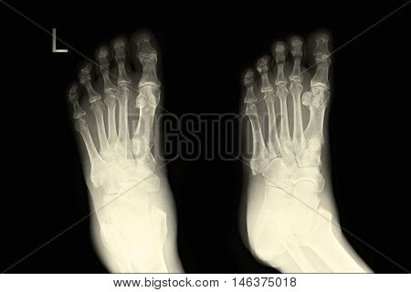 xray image show left foot AP,LAT  and fracture