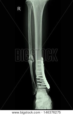 X-ray show fracture leg tibia and fibular and post operation