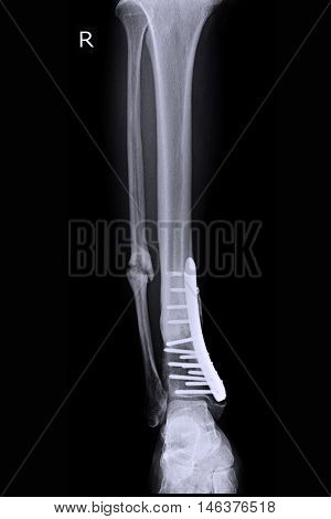 xray image show closed fracture tibia and fibula right foot