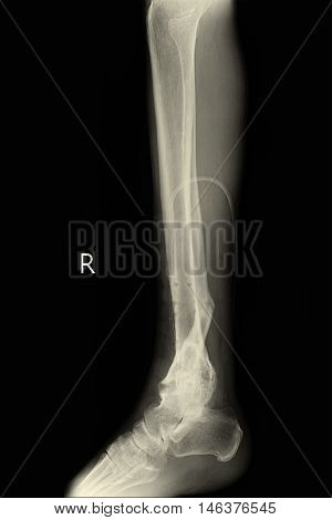 xray image show right foot and closed fracture tibia right