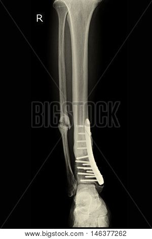 xray image show closed fracture tibia and fibula righ tfoot
