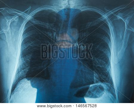 Doctor With Wing Made Of Ribs