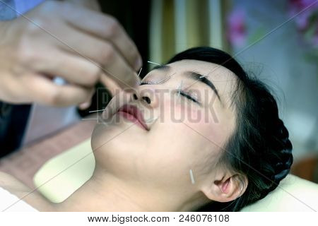 Young Woman Undergoing Acupuncture Treatment At The Health Spa.