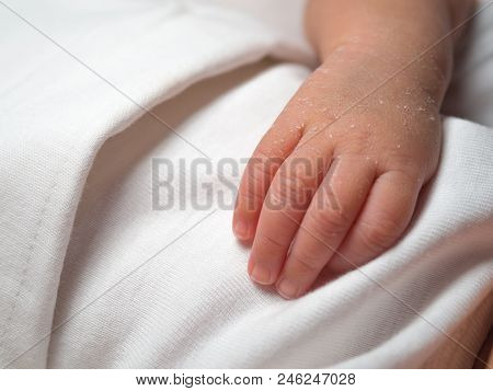 Closeup Hand Of A Newborn With A Skin Peeling On White Cloth. Skin Allergies In Newborn Called Verni