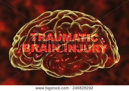 Traumatic Injury Of Human Brain, 3d Illustration. Conceptual Image Showing The Brain And Traumatic B