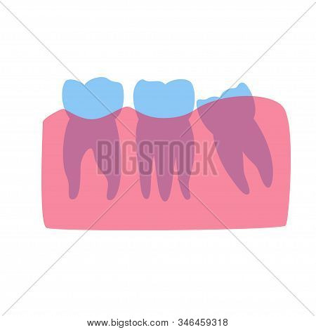 Vector Isolated Illustration Of Human Wisdom Tooth Mesial Impaction Anatomy. Human Jaws Model With M