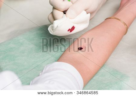 Male Hands In Medical Gloves Process Site Of Vein Puncture In Area Of Ulnar Bend Of Patient S Hand