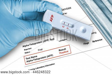 Alpha-fetoprotein (afp) Positive Test Result By Using Rapid Testing Device Held By Hand In Medical G