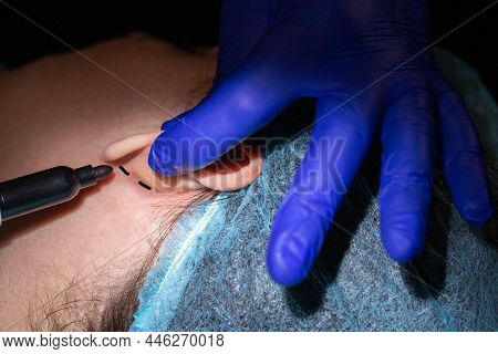 A Plastic Surgeon Performs An Operation To Correct The Ears Of A Female Patient. Otoplasty, Eliminat
