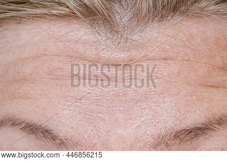 Woman Face Wrinkle On Forehead Before Rejuvination Procedures, Injections, Treatment, Surgery