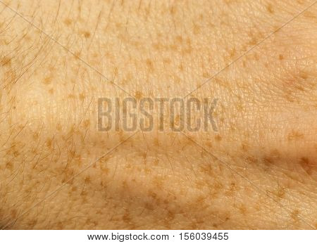 photographed close-up part of a man's hand, covered with orange freckles