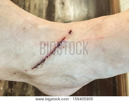 Skin scratch, macro shot of skin scratch, cat scratch, scratch wound, dry wound, injury, wounded foot scar, scared foot.