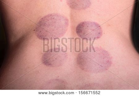 Cupping therapy on hirudo medicinalis human body. Hematoma after removing medical cans