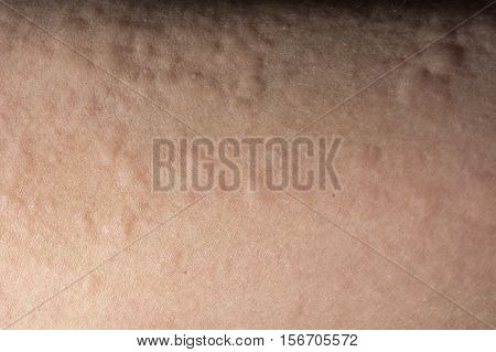 Close up of urticaria or allergy rash
