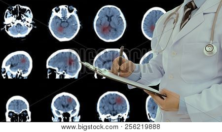 Doctor Diagnosis Image Mri Scan Brain, Ct Scan Of Brain Intracerebral Hemorrhage, Tumor.