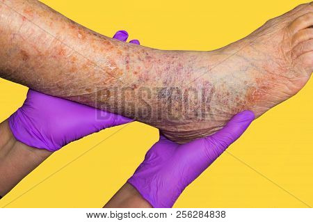 Close-up Of Skin With Varicose Veins On Senior Male Leg. Concept Of Dry Skin, Old Senior People, Var