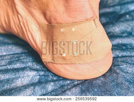 Heel With Plaster. Leg Of Sports Man With Blister Or Burn Wound On Blue Hospital Background.