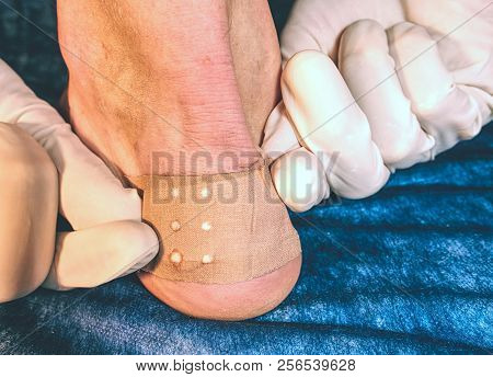 Nasty Burned Wound. Removing Of Burned Skin From Attached Place At Achilles Tendon.
