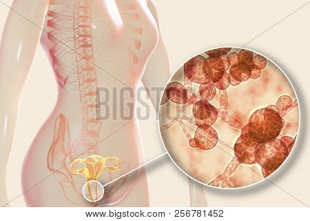 Vaginal Thrush, Female Candidiasis, 3d Illustration Showing Fungal Vaginitis And Close-up View Of Ye