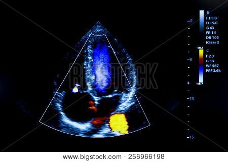 Colourful Image Of Modern Ultrasound Monitor. Ultrasonography Machine. High Technology Medical And H