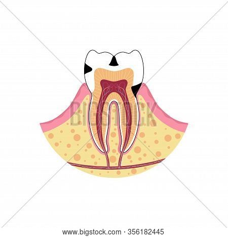 Vector Isolated Illustration Of Tooth With Caries. Types Of Teeth Decay Medical Poster. Banner For D