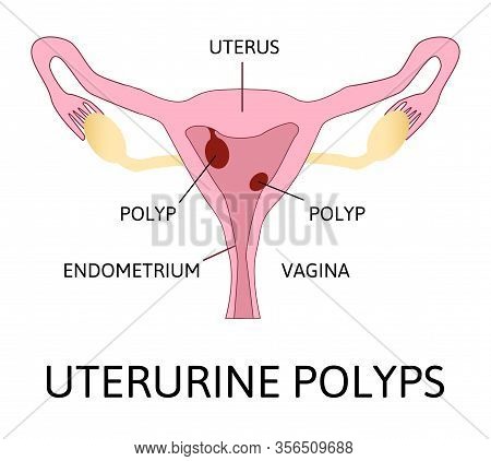 Uterine Polyps. Human Realistic Uterus. Anatomy Illustration.