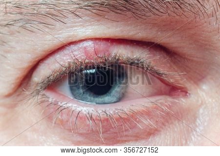 Chalazion On The Eyelid Of A Man Close-up.
