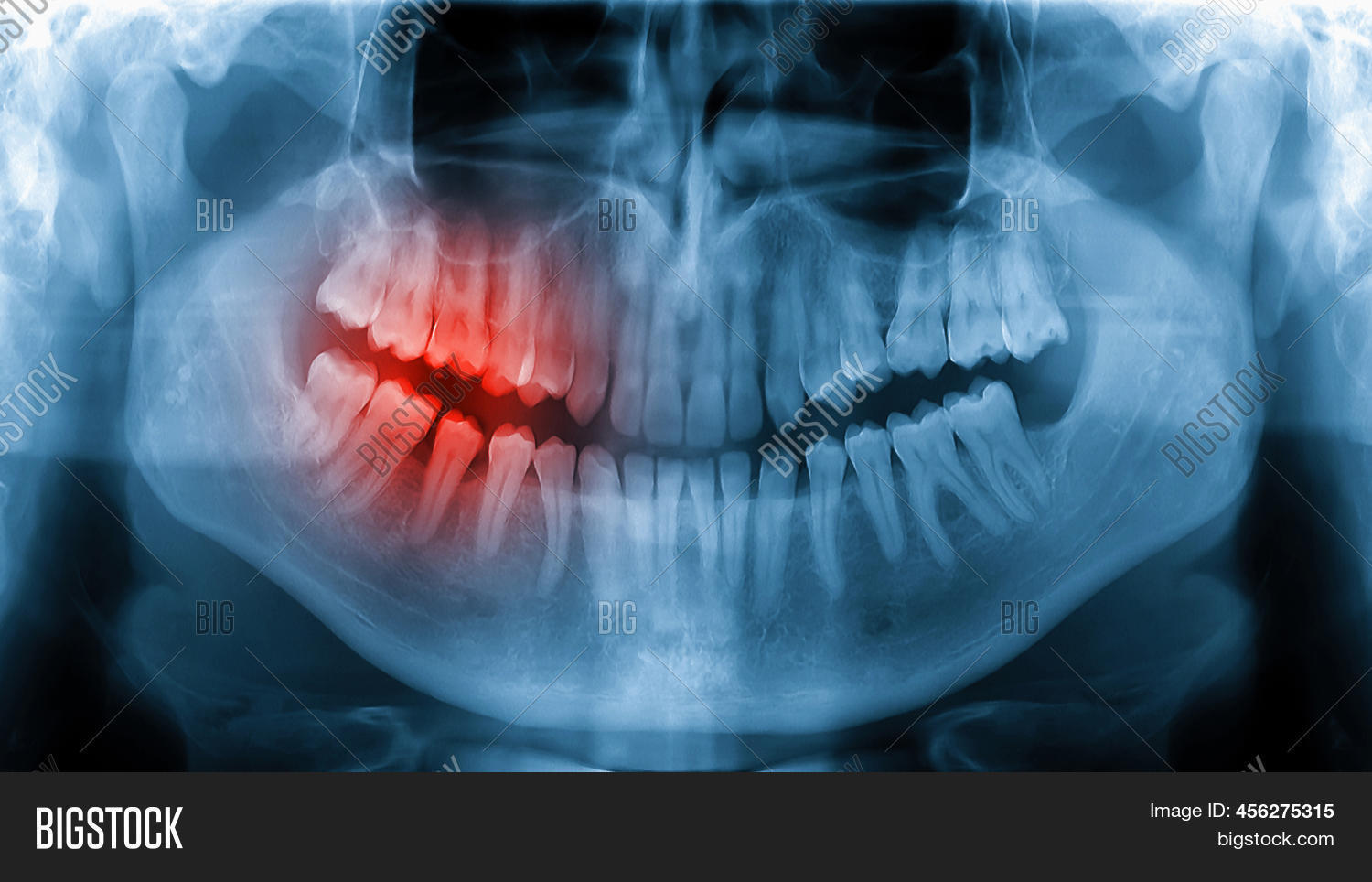 Toothache Xray Image & Photo (Free Trial) Bigstock