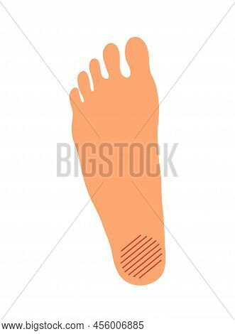 Plantar Fasciitis Problem On The Female Foot. Orthopedic Deformity Of The Joint And Bone. Women Leg.