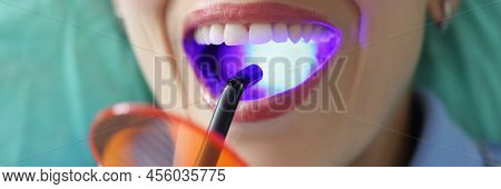 Close-up Of Woman With Open Mouth On Dentist Appointment Try Whitening Procedure. Special Tool With 