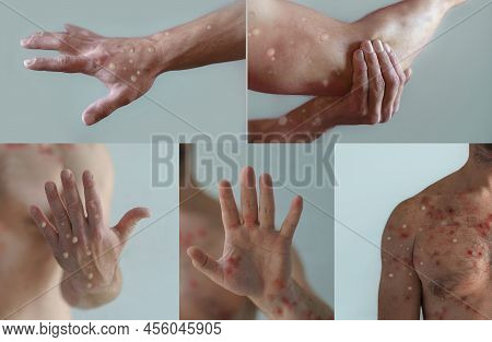 Collage Of Male Body Parts Affected By Blistering Rash Because Of Monkeypox Or Other Viral Infection