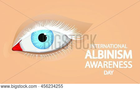 International Albinism Awareness Day Eye, Vector Art Illustration.
