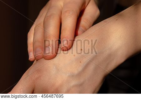 Birthmarks On Skin Close Up Detail Of The Bare Skin Sun Exposure Effect On Skin, Health Effects Of U
