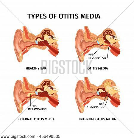 Realistic Anatomy Ear Otitis Set Of Four Isolated Anatomic Diagrams With Text Captions And Internal 