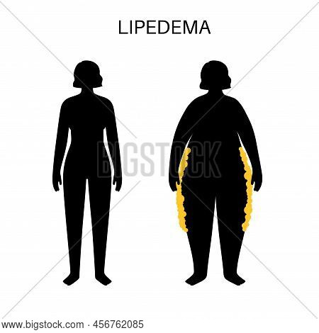 Lipedema Disease Concept. Accumulating Fat In The Lover Part Of The Female Body. Buttocks, Hips And 