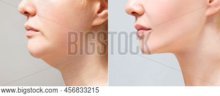 A Close Portrait Of An Aged Woman Before And After Facial Rejuvenation Procedure. Correction Of The 