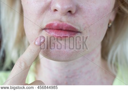 Real Skin Biorevitalization On White Background. Traces Of Biorevitalization Injections On Woman Fac