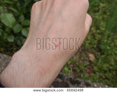 Hand Scar