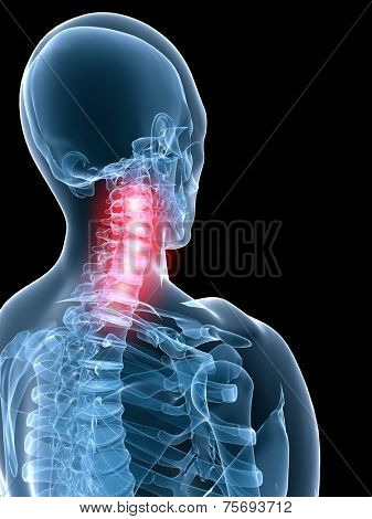 neck pain